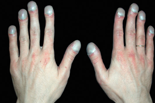 Фото болезней ногтей рук в руки