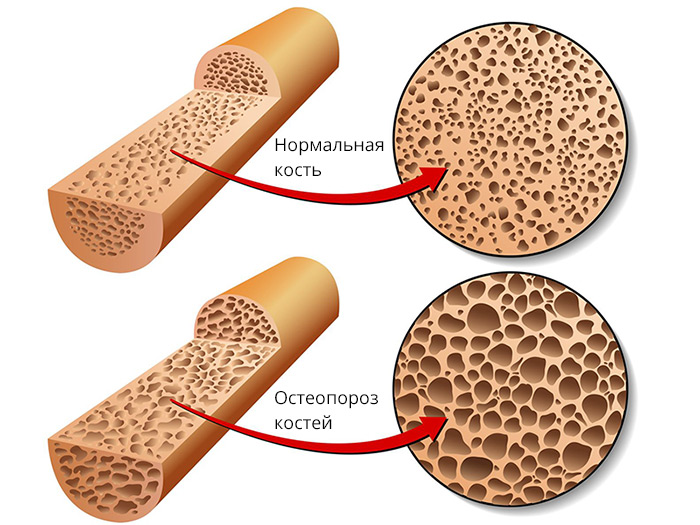 Остеопороз: симптомы и лечение у женщин. Как лечить остеопороз