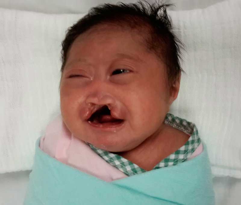 Синдром эдвардса фото новорожденных википедия