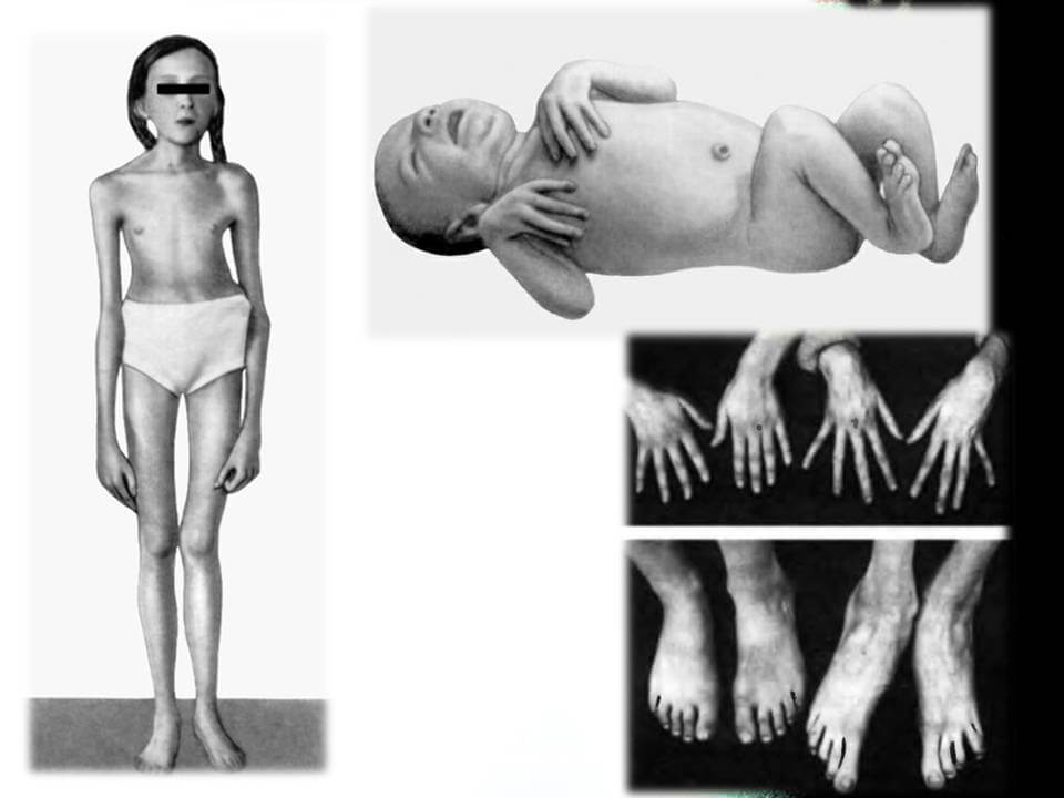 Синдром марфана фото больных людей на ранней стадии thumbnail