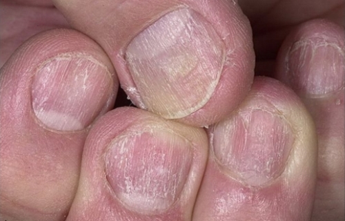 Что за болезнь когда ногти портятся