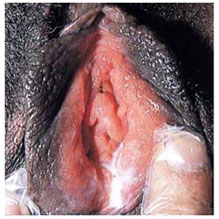 Сыпь у женщин гонорея фото