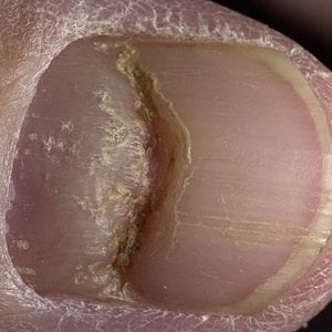Определить болезни по ногтевой пластине с фото 103