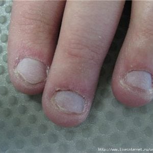 Болезнь по ногтям пальцев рук 102