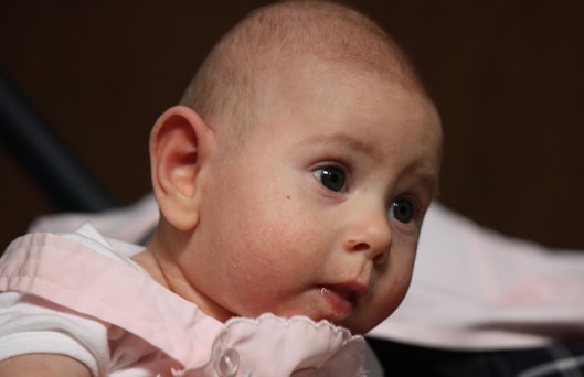 Фото новорожденного с синдромом патау