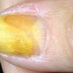 Определить болезни по ногтевой пластине с фото 111