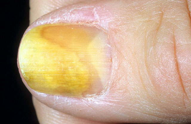 Болезни внутренних органов при болезни ногтей