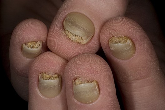 Как называется болезнь когда большие ногти