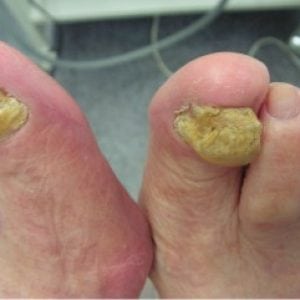 Заболевание ногтей на ногах лечение фото