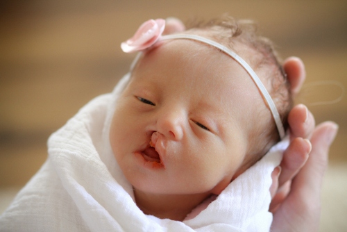Что это такое синдром эдвардса фото новорожденных thumbnail