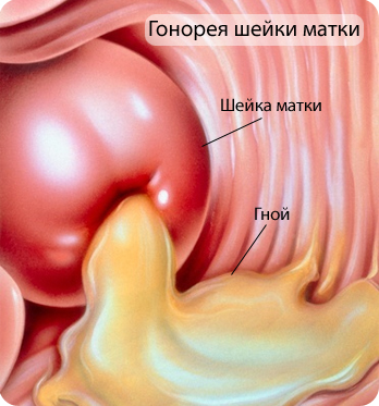 Сыпь у женщин гонорея фото