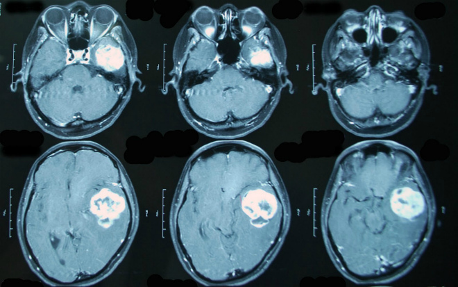 Глиоз головного мозга прогноз жизни лечение народными средствами