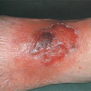Стафилококковая инфекция на коже фото у взрослых 39