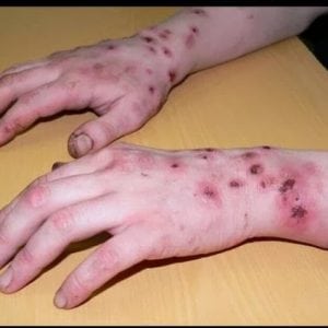 Стафилококковая инфекция на коже фото у взрослых 45