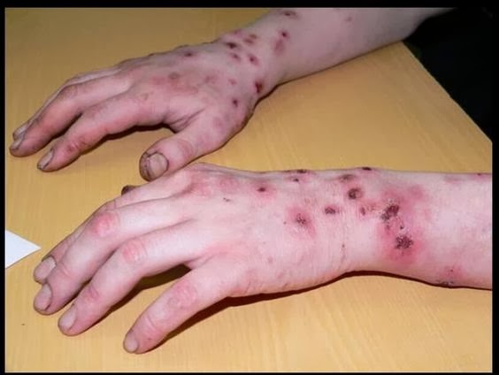 Стафилококк кожи рук лечение