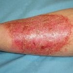 Стафилококк на коже лечение 34