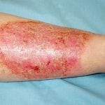 Стафилококк на коже лечение 33