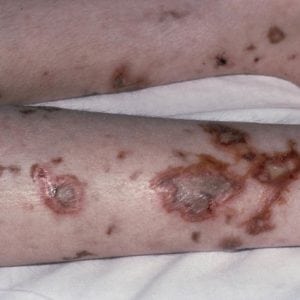 Стафилококковая инфекция на коже фото у взрослых 46