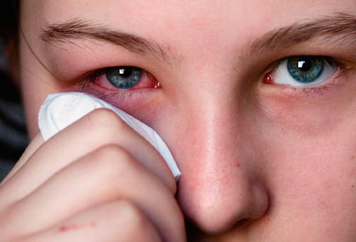 Какие симптомы аллергии на пыльцу thumbnail
