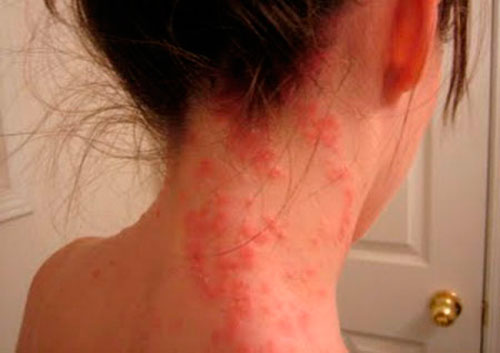 Аллергия на пыльцу симптомы фото thumbnail