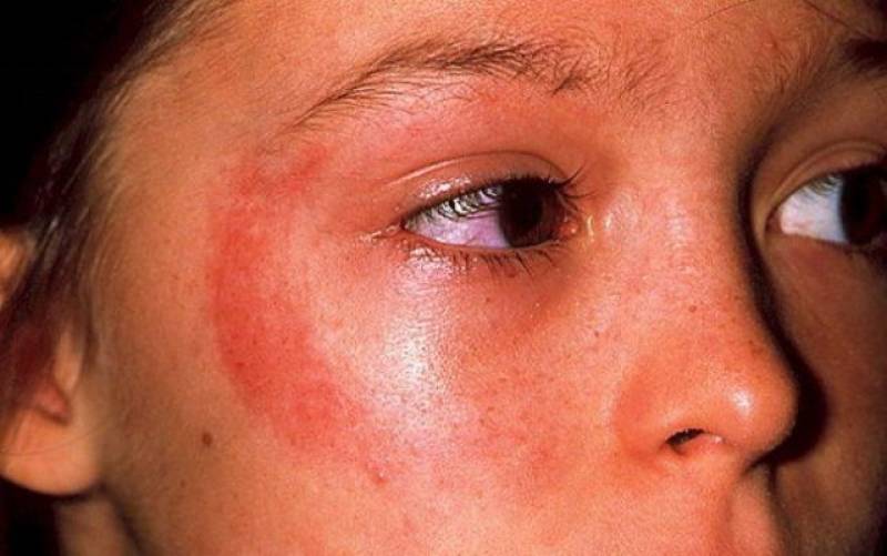 Как выглядит аллергия на солнце фото у взрослых фото