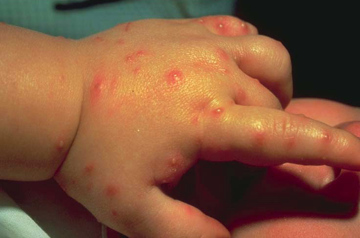 Аллергия на укусы комаров температура