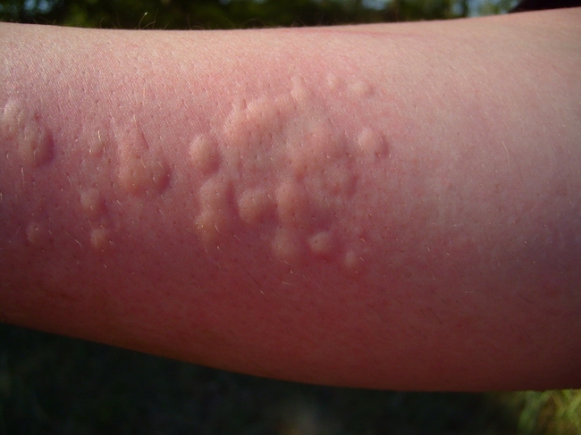 Аллергия на укусы комаров температура