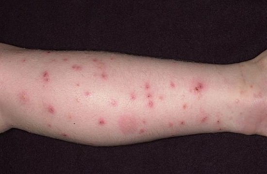 Аллергия на укусы комаров температура thumbnail
