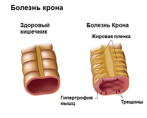 Признаки болезни кишечника и прямой кишки thumbnail