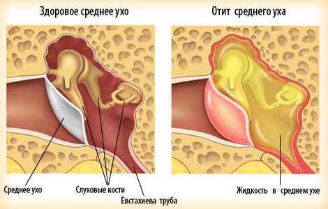 Как выглядит отит внутри уха