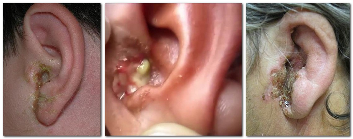 Отит среднего уха симптомы фото thumbnail