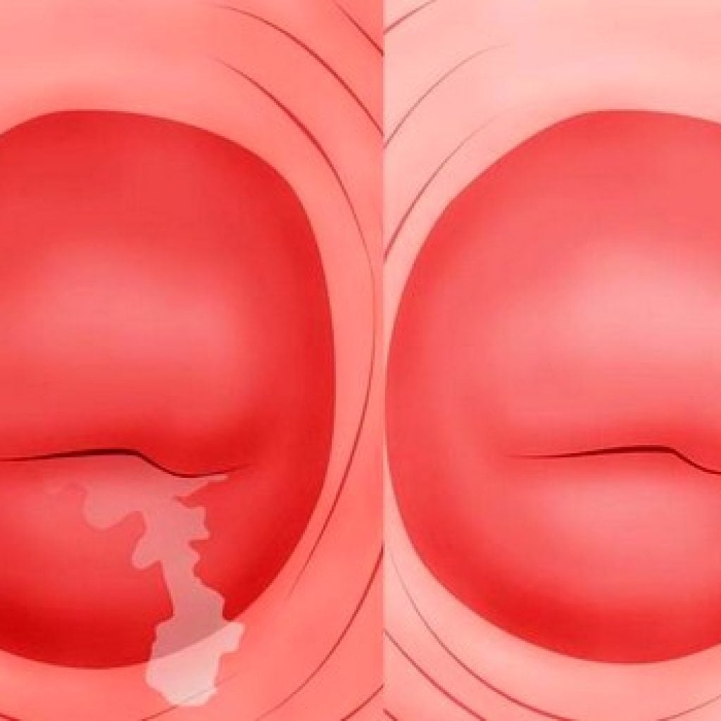 Цервикальный канал в менопаузе