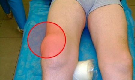 Что такое мениск коленного сустава? Разрыв мениска коленного сустава: причины, симптомы, лечение
