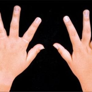 Ювенильный ревматоидный артрит у детей и подростков: симптомы и лечение