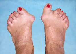 Причины болезни большого пальца на ноге