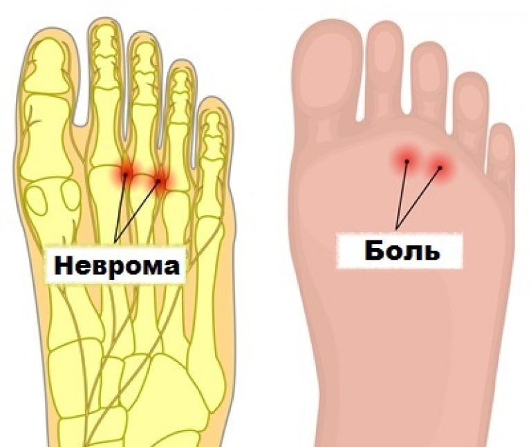 Почему болит палец на правой ноге. Неврома Мортона симптомы. Неврома Мортона на пальцах ног.