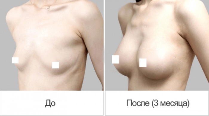 Противопоказания к установке грудных имплантов