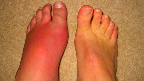 Болит сустав большого пальца на ноге причины и лечение thumbnail