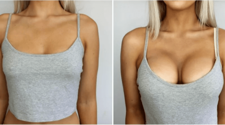 Увеличение груди операция противопоказания