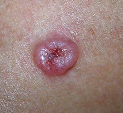 базальноклеточный рак кожи лица thumbnail