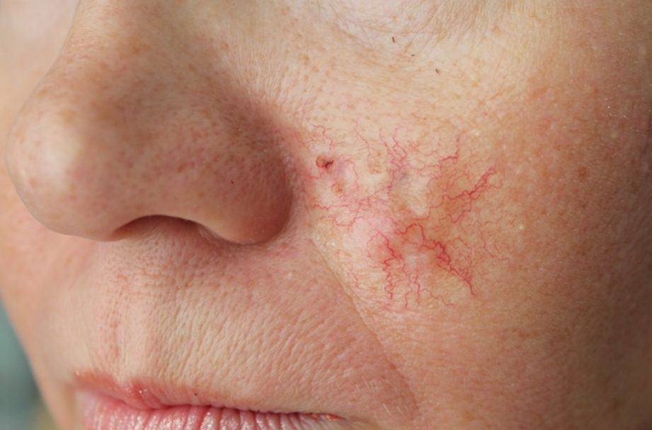 Базалима кожи: фото, как выглядит, лечение и прогноз выживаемости при раке кожи