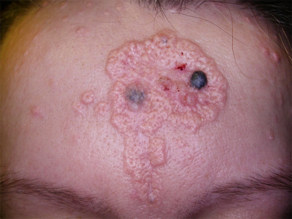 Базально клеточный рак кожи лица это