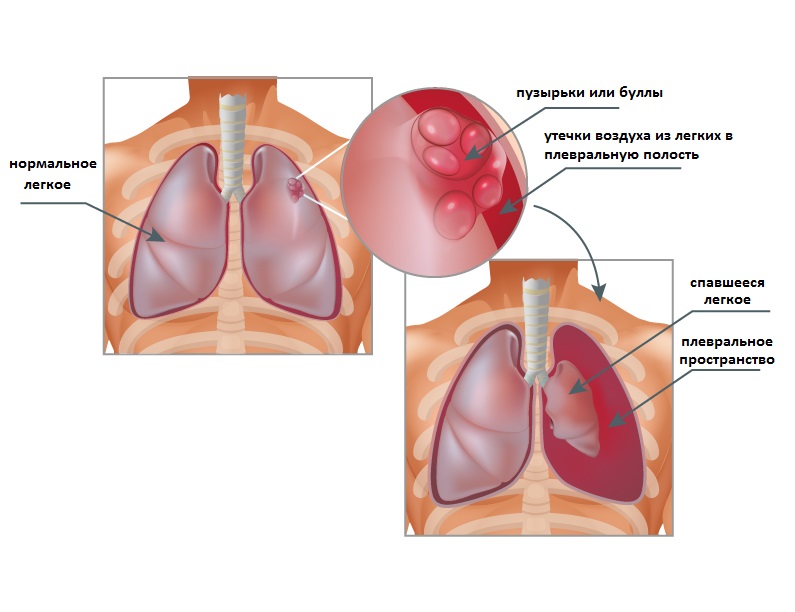Боль в грудной клетке посередине при кашле и ком в горле