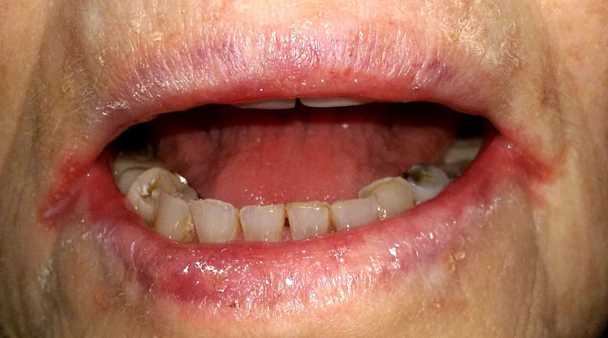 Губы воспаление красной каймы губ