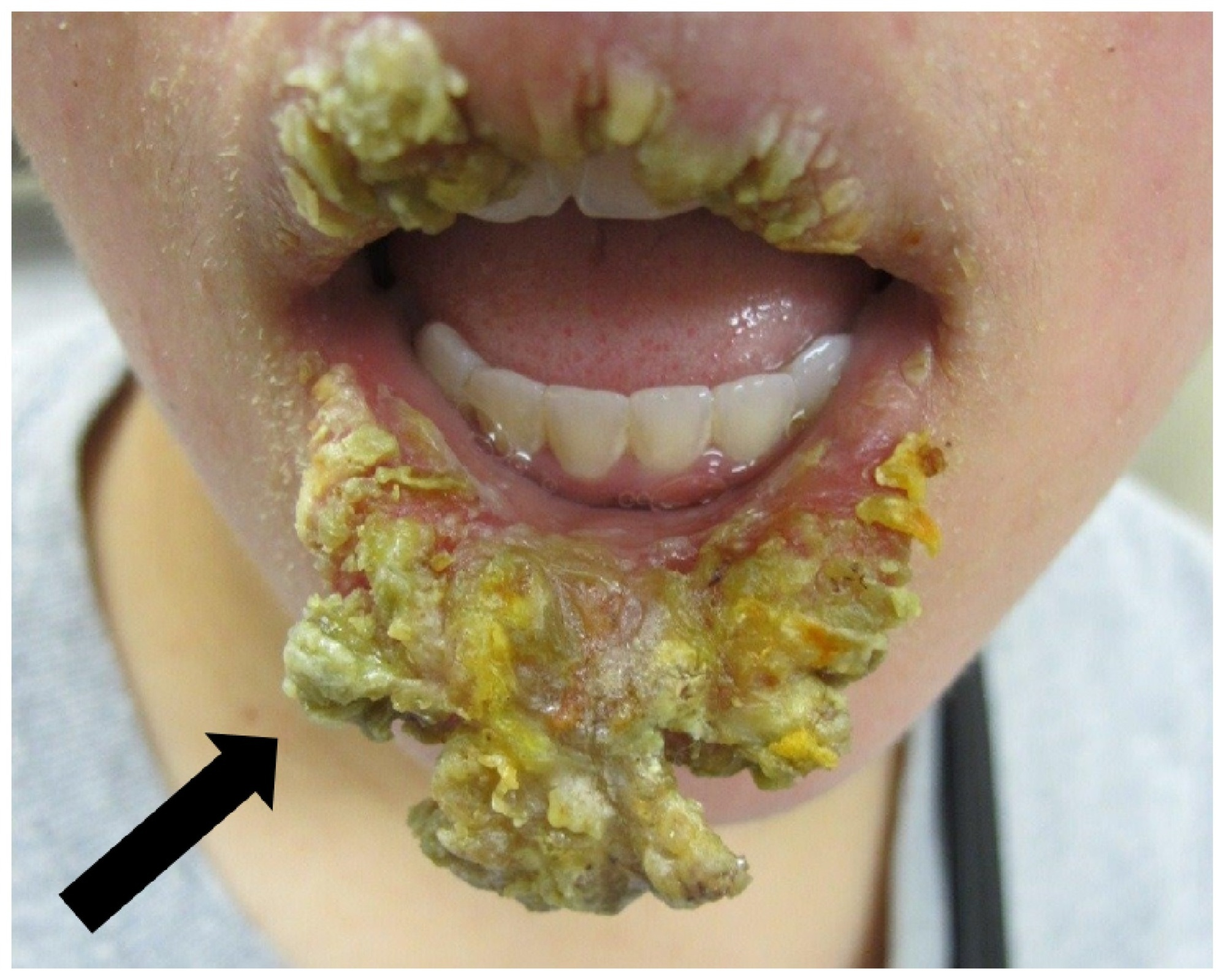 Как вылечить воспаление губ thumbnail