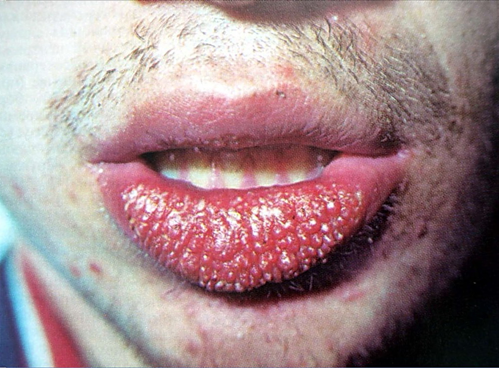 Губы воспаление красной каймы губ