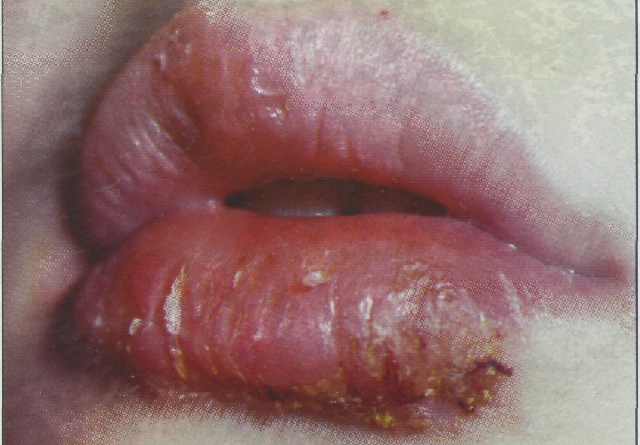 Воспаление губы лечение в домашних условиях thumbnail