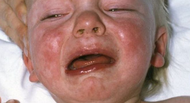 Краснуха у детей симптомы и лечение профилактика вируса