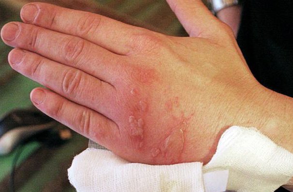 Лечение кожи после ожога кипятком