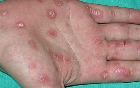 Есть ли болезни похожие на сифилис thumbnail
